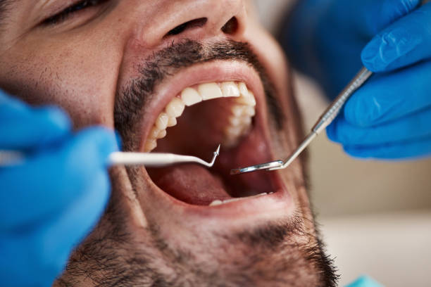 Best Knocked-Out Tooth (Avulsed Tooth) Treatment in Goleta, CA
